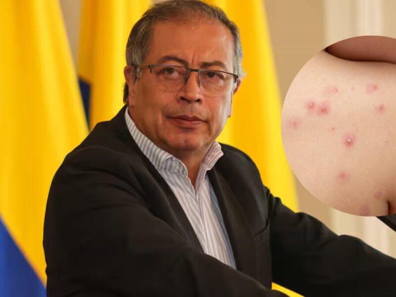 colombia se prepara ante la emergencia sanitaria mundial por la viruela del mono colombia se prepara ante la emergencia sanitaria mundial por la viruela del mono web 2024 08 14t161537.920