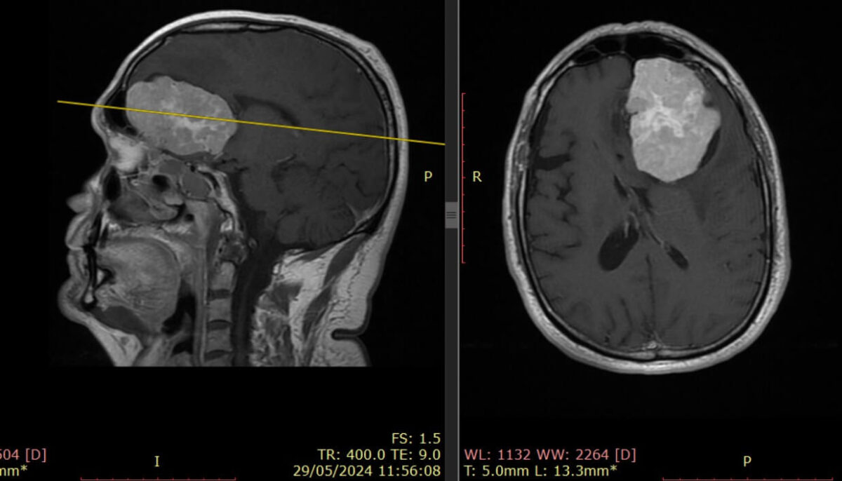 cientificos identifican proteinas clave para diagnosticar y monitorear tumores cerebrales meningioma. tumor cerebral. dr. torales hospital el pilar barcelona