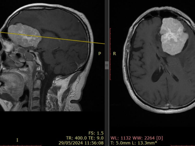 Científicos identifican proteínas clave para diagnosticar y monitorear tumores cerebrales
